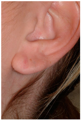 ear lobe repair dr. diaz